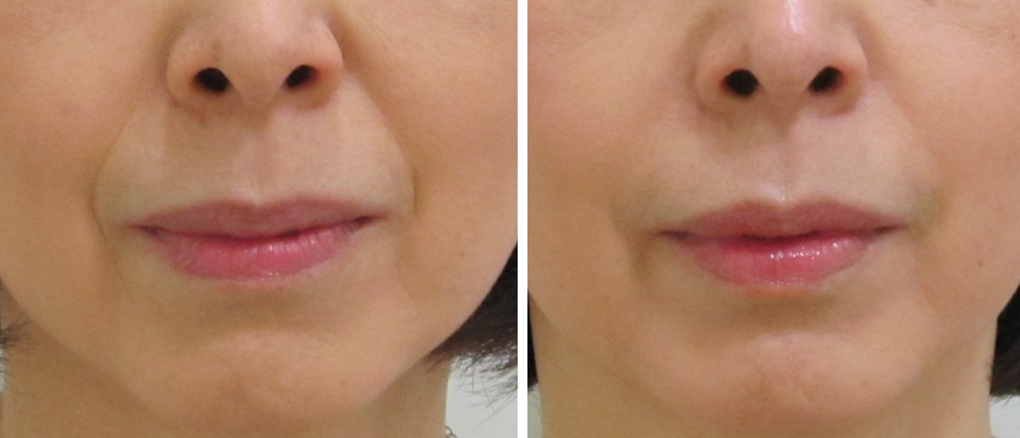 レチノール エキスパート0.1%IOPEの効果に関する口コミ - 首のシワやほうれい線が気になるアラフォーで by Fuyuko NakaueLIPS