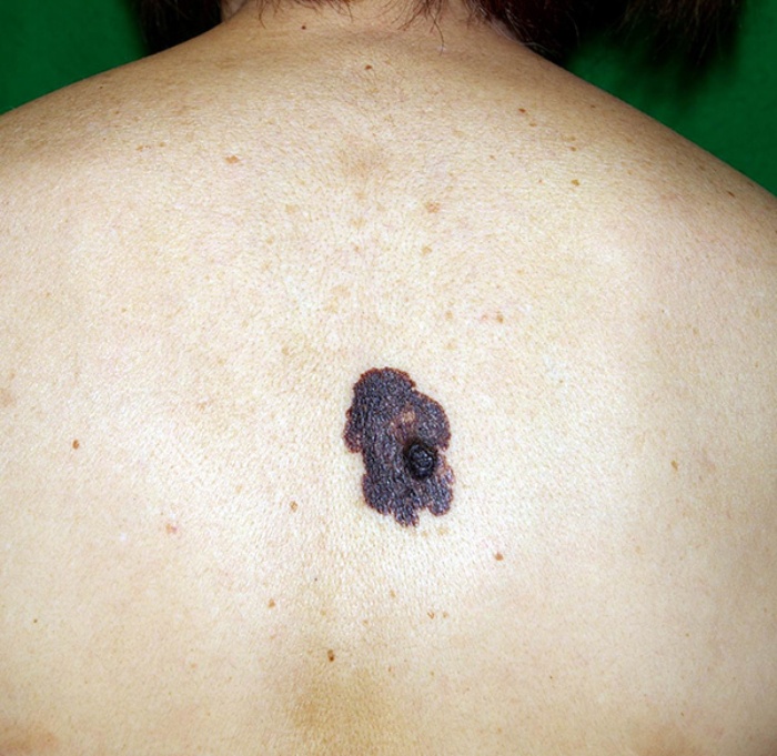 尋常性乾癬 じんじょうせいかんせん- 板橋区成増駅前かわい皮膚科