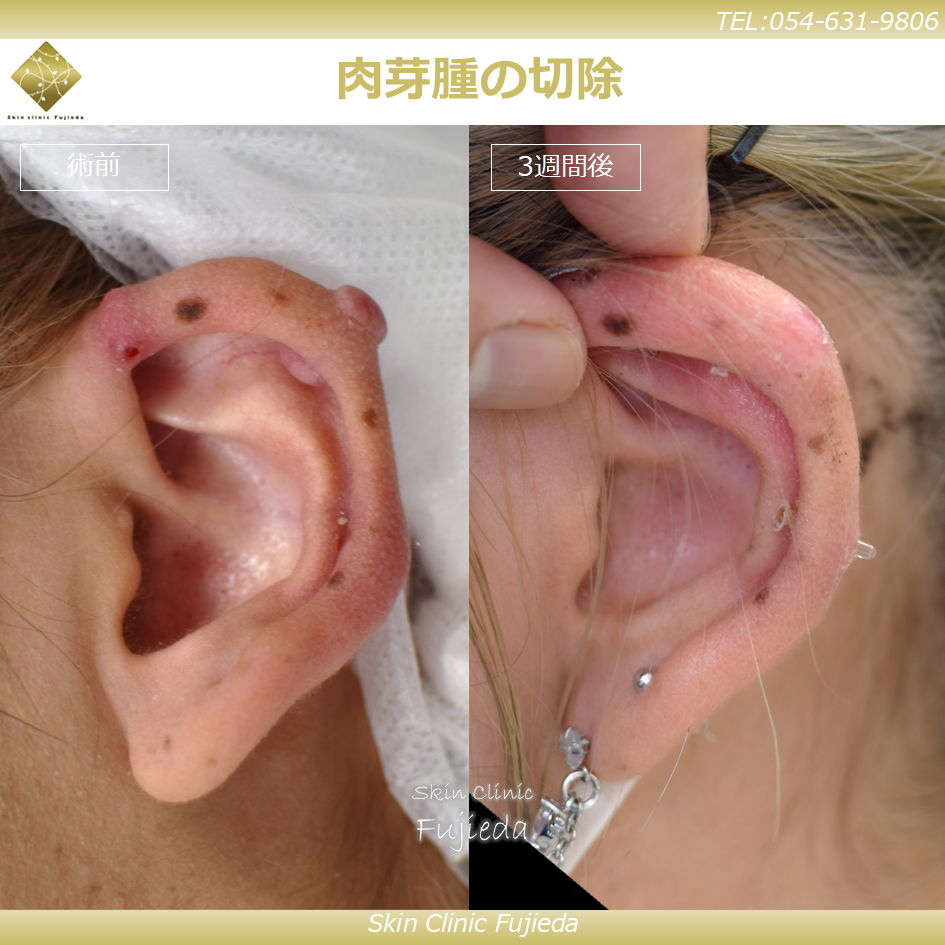 肉芽や汗によるかぶれなどボディピアスのケア方法 - 4ages