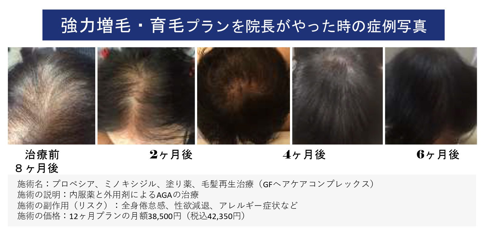 ミノキシジルによる初期脱毛の期間や仕組みを解説やばいと言われる理由とは？ベアAGAクリニック新宿で薄毛治療なら当クリニック