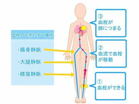 肺血栓塞栓症・エコノミークラス症候群 男性 のイラスト – フリーイラスト素材集 KuKuKeKe