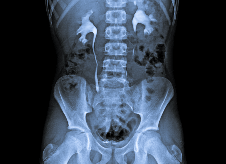 腎・尿管結石の頻度など天王寺で泌尿器科をお探しなら駅直結の「山本クリニック」へ