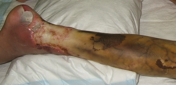 熱傷 やけど医療法人社団 美啓会 ぎふスキンケアクリニック – 岐阜市の形成外科・美容外科・美容皮膚科