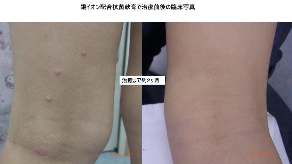 水いぼ 伝染性軟属腫 吹田市の皮膚科もりはら皮ふ科クリニック