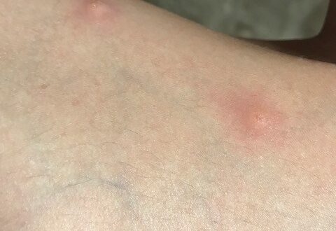 虫さされチェックアース害虫駆除なんでも事典