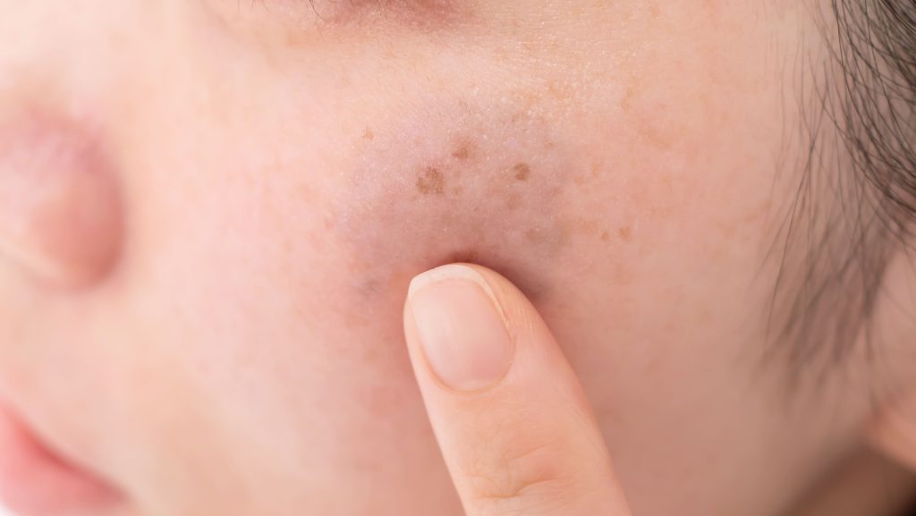 ニキビの芯はいったい何？ その特徴と対処法を詳しく解説！CLINIC FOR