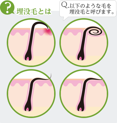 毛抜きが抜けない時の復活方法と毛抜きで根元から痛くなく抜くコツエピステ