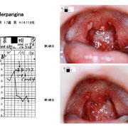 大人もかかるヘルパンギーナ 知っておきたい予防と治療病気スコープ