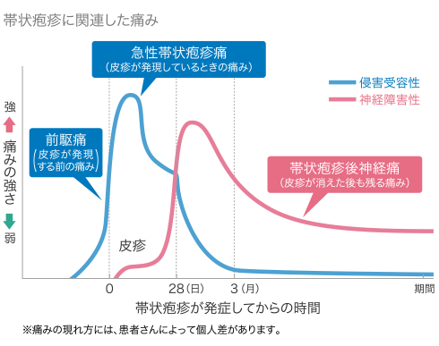 帯状疱疹、痛み慢性化も～ワクチン接種で予防～こちら診察室時事メディカル時事通信の医療ニュースサイト