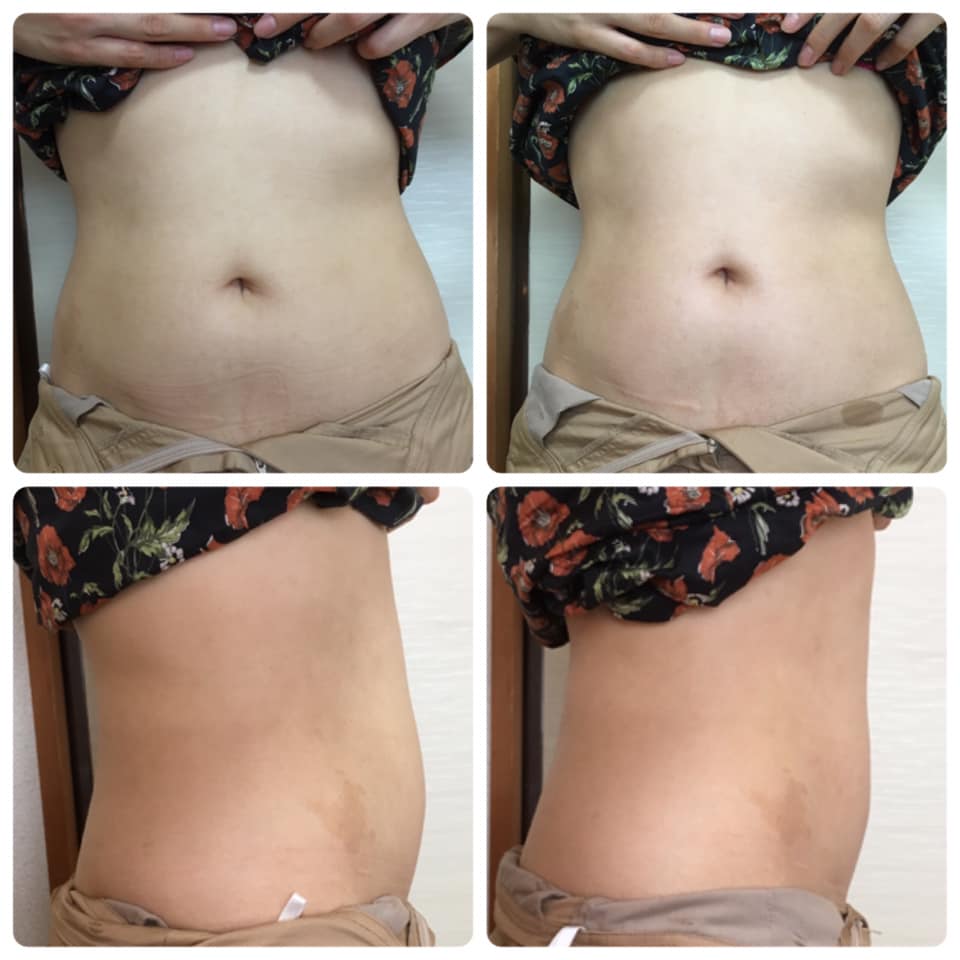 お腹太り＆お腹痩せ ダイエットビフォーアフター イラスト入りの写真素材73133179- PIXTA