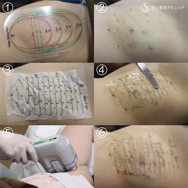 わきが手術 スリーミックス法 の術中所見、経過について静岡美容外科 橋本クリニック 院長ブログ