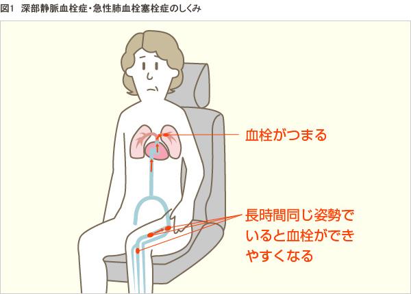 エコノミークラス症候群震災時に起こりやすい健康問題と予防法 1看護roo! カンゴルー